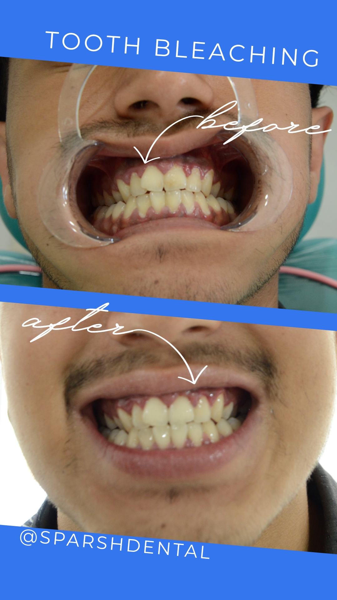 Tooth Bleaching Before After Results